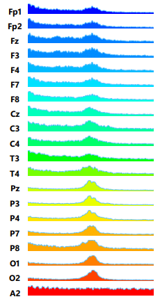 EEG results of patient brain following TMS treatment for depression